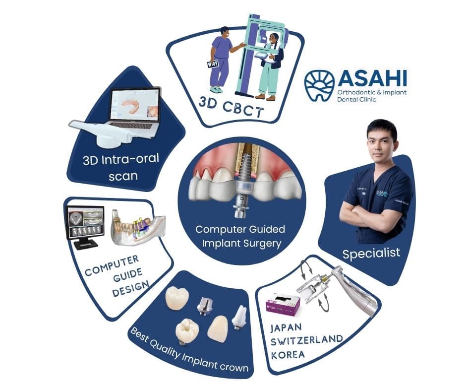 Computer Assisted Implant Surgery workflow at Asahi Dental Specialist Clinic