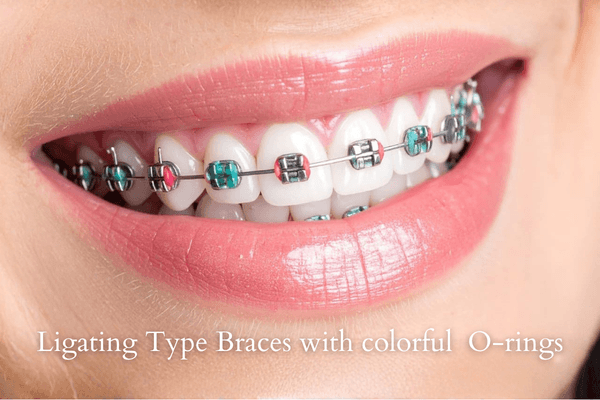 Ligating type traditional braces treatment